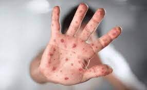 شباهت علائم آبله میمونی و آبله مرغان