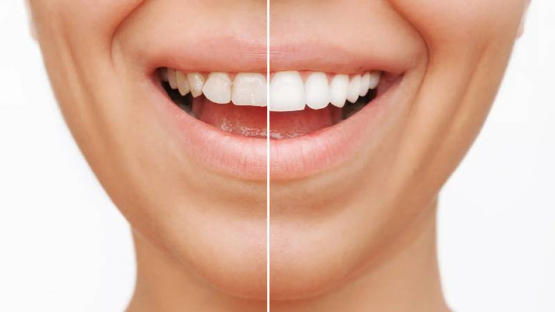 مزایای کامپوزیت ونیر دکتر مانوشا امیری